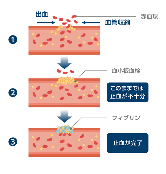図：血友病と止血の仕組み