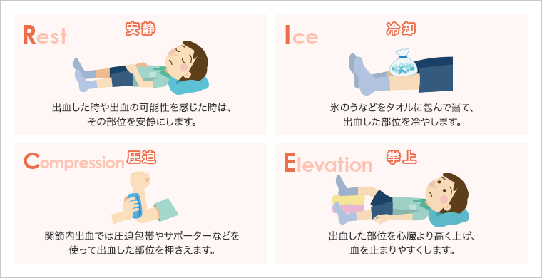 説明イラスト:出⾎時の補助的ケア:RICE